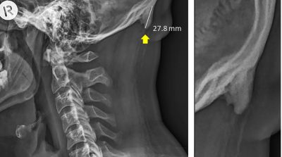 Phát hiện cấu trúc xương kỳ lạ sau đầu của người trẻ hiện đại