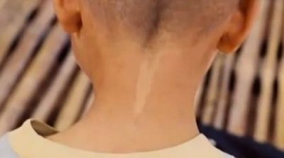 Những vết bớt bẩm sinh phải chăng là dấu hiệu của kiếp trước?